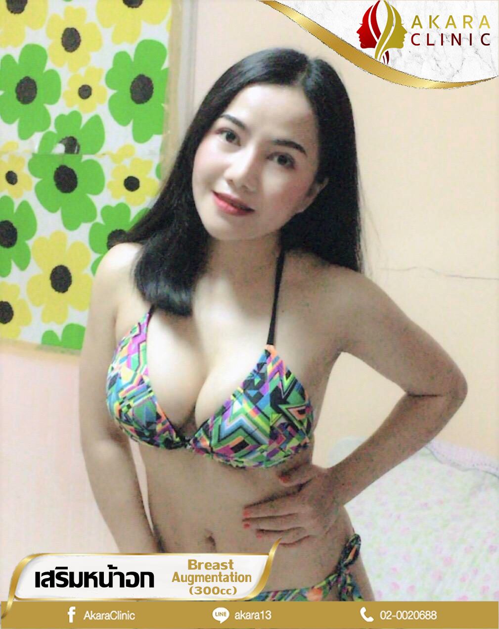 เสริมหน้าอก  (Breast Surgery)